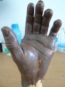 Wax sculpture of patient who has the middle 3 fingers missing
